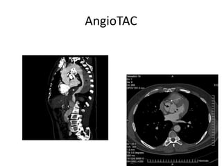 AngioTAC
 