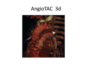 AngioTAC 3d
 