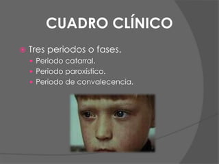 CUADRO CLÍNICO
 Tres periodos o fases.
 Periodo catarral.
 Periodo paroxístico.
 Periodo de convalecencia.
 