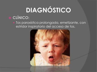DIAGNÓSTICO
 CLÍNICO:
 Tos paroxística prolongada, emetizante, con
estridor inspiratorio del acceso de tos.
 