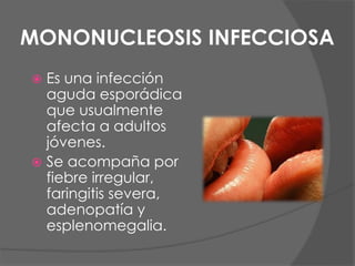 MONONUCLEOSIS INFECCIOSA
 Es una infección
aguda esporádica
que usualmente
afecta a adultos
jóvenes.
 Se acompaña por
fiebre irregular,
faringitis severa,
adenopatía y
esplenomegalia.
 