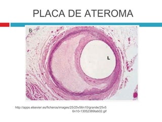 PLACA DE ATEROMA




http://apps.elsevier.es/ficheros/images/25/25v56n10/grande/25v5
                                         6n10-13052389tab02.gif
 