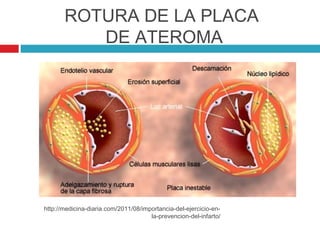 ROTURA DE LA PLACA
          DE ATEROMA




http://medicina-diaria.com/2011/08/importancia-del-ejercicio-en-
                                      la-prevencion-del-infarto/
 