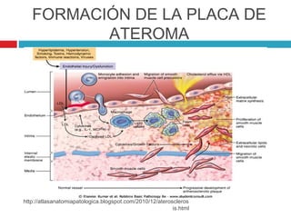 FORMACIÓN DE LA PLACA DE
          ATEROMA




http://atlasanatomiapatologica.blogspot.com/2010/12/ateroscleros
                                                          is.html
 