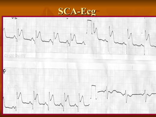 SCA-Ecg 