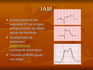 IAM El supradesnivel del segmento ST es el signo patognomónico de infarto agudo de miocardio. Acompañado de síntomas y  posteriormente  movimiento enzimático. También el BCRI agudo con angor. 