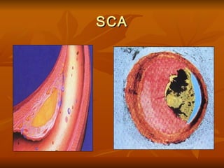 SCA 
