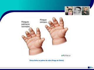 Única linha na palma da mão (Prega de Símio)
 