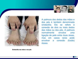 A palmura dos dedos das mãos e
dos pés é também denominada
sindactilia. Ela se refere à
conexão de dois ou mais dedos
das mãos ou dos pés. A palmura
normalmente envolve uma
ligação de pele entre duas áreas,
mas em casos raros pode
envolver a conexão (fusão)
óssea.
Sindactilia nas mãos e nos pés
 
