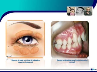 Dobras de pele em cima da pálpebra
superior (epicanto)
Dentes projetados para frente (tamanho
normal)
 