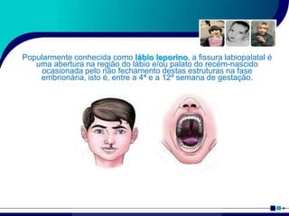 Popularmente conhecida como lábio leporino, a fissura labiopalatal é
uma abertura na região do lábio e/ou palato do recém-nascido
ocasionada pelo não fechamento destas estruturas na fase
embrionária, isto é, entre a 4ª e a 12ª semana de gestação.
 
