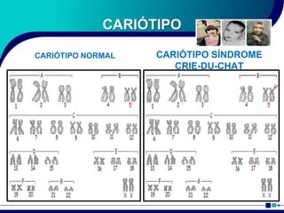 CARIÓTIPO
CARIÓTIPO NORMAL CARIÓTIPO SÍNDROME
CRIE-DU-CHAT
 