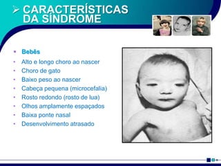  CARACTERÍSTICAS
DA SÍNDROME
 Bebês
• Alto e longo choro ao nascer
• Choro de gato
• Baixo peso ao nascer
• Cabeça pequena (microcefalia)
• Rosto redondo (rosto de lua)
• Olhos amplamente espaçados
• Baixa ponte nasal
• Desenvolvimento atrasado
 