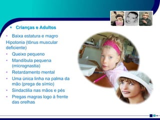  Crianças e Adultos
• Baixa estatura e magro
Hipotonia (tônus muscular
deficiente)
• Queixo pequeno
• Mandíbula pequena
(micrognastia)
• Retardamento mental
• Uma única linha na palma da
mão (prega de símio)
• Sindactilia nas mãos e pés
• Pregas magras logo à frente
das orelhas
 