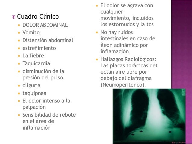 El tratamiento medicamentoso de la neuralgia intercostal de la osteocondrosis