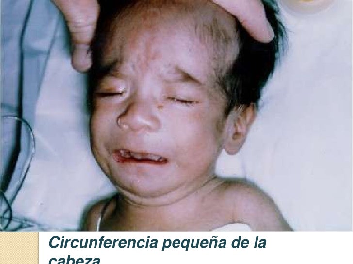 Síndrome de alcohol fetal