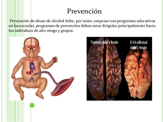 La codificación por la acupuntura del alcoholismo
