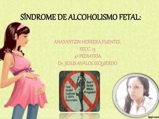 SÍNDROME DE ALCOHOLISMO FETAL:
ANAYANTZIN HERRERAFUENTES.
SECC. 13
4º PEDIATRÍA
Dr. JESÚS AVALOS IZQUIERDO
 