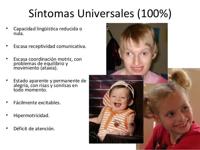 Sindrome De Angelman Sindrome De Angelman