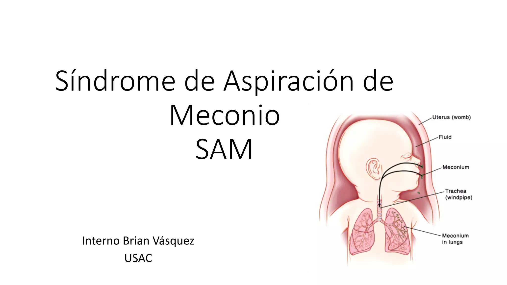 Síndrome de Aspiración de Meconio (SAM) | PPT
