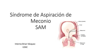 Síndrome de Aspiración de
Meconio
SAM
Interno Brian Vásquez
USAC
 