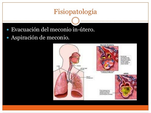 Síndrome de aspiración meconial