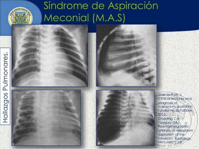 Síndrome de aspiración meconial 2015.