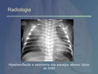 Radiologia
Hiperinsuflação e assimetria dos espaços aéreos: típico
de SAM
 
