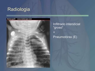 Radiologia
Infiltrado intersticial
“groso”
+
Pneumotórax (E)
 