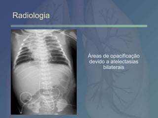 Radiologia
Áreas de opacificação
devido a atelectasias
bilaterais
 