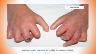 Bolognia J, Schaffer J, Cerroni L. 4th Ed. 2018. Dermatología. ELSEVIER.
Fase tardía
 