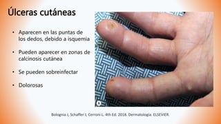 Úlceras cutáneas
• Aparecen en las puntas de
los dedos, debido a isquemia
• Pueden aparecer en zonas de
calcinosis cutánea
• Se pueden sobreinfectar
• Dolorosas
Bolognia J, Schaffer J, Cerroni L. 4th Ed. 2018. Dermatología. ELSEVIER.
 