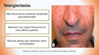 Telangiectasias
Aparecen con mayor frecuencia en
cara, labios y palmas
Máculas planas que muestran vasos
enmarañados
Más frecuente en esclerosis localizada
que diseminada
Bolognia J, Schaffer J, Cerroni L. 4th Ed. 2018. Dermatología. ELSEVIER.
 