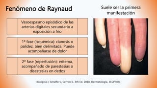Fenómeno de Raynaud
Bolognia J, Schaffer J, Cerroni L. 4th Ed. 2018. Dermatología. ELSEVIER.
Vasoespasmo episódico de las
arterias digitales secundario a
exposición a frío
1ª fase (isquémica): cianosis o
palidez, bien delimitada. Puede
acompañarse de dolor
2ª fase (reperfusión): eritema,
acompañado de parestesias o
disestesias en dedos
Suele ser la primera
manifestación
 