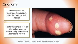 Calcinosis
Bolognia J, Schaffer J, Cerroni L. 4th Ed. 2018. Dermatología. ELSEVIER.
Neoformaciones del color
de la piel de aspecto
empedrado y eliminación
de material yesoso
Más frecuente en
extremidades, cerca de
articulaciones y zonas
distales
 