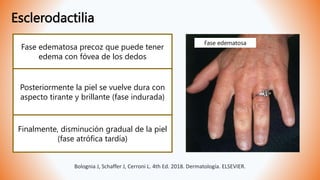 Esclerodactilia
Fase edematosa precoz que puede tener
edema con fóvea de los dedos
Posteriormente la piel se vuelve dura con
aspecto tirante y brillante (fase indurada)
Finalmente, disminución gradual de la piel
(fase atrófica tardía)
Fase edematosa
Bolognia J, Schaffer J, Cerroni L. 4th Ed. 2018. Dermatología. ELSEVIER.
 
