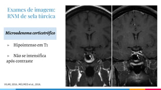 Exames de imagem:
RNM de sela túrcica
Microadenoma corticotrófico
▷ Hipointenso em T1
▷ Não se intensifica
após contraste
VILAR, 2016 ; MELMED et al., 2016.
 
