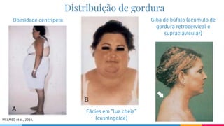 Obesidade centrípeta
Fácies em “lua cheia”
(cushingoide)
Giba de búfalo (acúmulo de
gordura retrocervical e
supraclavicular)
Distribuição de gordura
MELMED et al., 2016.
 