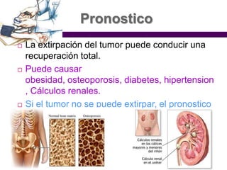 PronosticoLa extirpación del tumor puede conducir una recuperación total.Puede causar obesidad, osteoporosis, diabetes, hipertension, Cálculos renales.Si el tumor no se puede extirpar, el pronostico será malo.