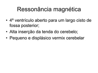 Ressonância magnética 
• 4º ventrículo aberto para um largo cisto de 
fossa posterior; 
• Alta inserção da tenda do cerebelo; 
• Pequeno e displásico vermix cerebelar 
 