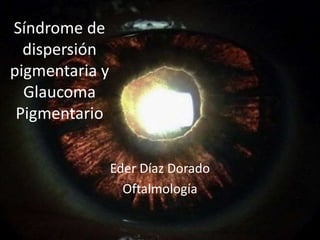 Síndrome de
dispersión
pigmentaria y
Glaucoma
Pigmentario
Eder Díaz Dorado
Oftalmología
 