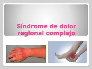 Síndrome de dolor 
regional complejo 
 