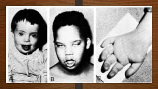 Cabeza
•   Braquicefalia.
•   Fontanelas granes.               • Orejas: pequeñas y con el hélix
                                       levemente plegado
•   Nariz pequeña.
•   Cabello fino y lacio
•   Ojos:                            • Boca: macroglosia, lengua
                                       geográfica, pequeño tamaño de la
     • Fisura palpebral oblicua        boca y falta de tonicidad muscular.
     • Pliegues epicánticos.
 