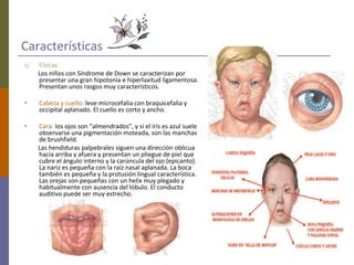 Características
1) Físicas:
Los niños con Síndrome de Down se caracterizan por
presentar una gran hipotonía e hiperlaxitud ligamentosa.
Presentan unos rasgos muy característicos.
• Cabeza y cuello: leve microcefalia con braquicefalia y
occipital aplanado. El cuello es corto y ancho.
• Cara: los ojos son “almendrados”, y si el iris es azul suele
observarse una pigmentación moteada, son las manchas
de brushfield.
Las hendiduras palpebrales siguen una dirección oblicua
hacia arriba y afuera y presentan un pliegue de piel que
cubre el ángulo interno y la carúncula del ojo (epicanto).
La nariz es pequeña con la raíz nasal aplanada. La boca
también es pequeña y la protusión lingual característica.
Las orejas son pequeñas con un helix muy plegado y
habitualmente con ausencia del lóbulo. El conducto
auditivo puede ser muy estrecho.
 