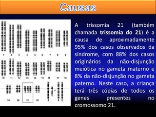 A trissomia 21 (também
chamada trissomia do 21) é a
causa de aproximadamente
95% dos casos observados da
síndrome, com 88% dos casos
originários da não-disjunção
meiótica no gameta materno e
8% da não-disjunção no gameta
paterno. Neste caso, a criança
terá três cópias de todos os
genes
presentes
no
cromossomo 21.

 