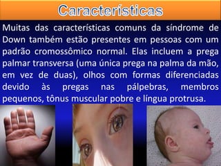 Muitas das características comuns da síndrome de
Down também estão presentes em pessoas com um
padrão cromossômico normal. Elas incluem a prega
palmar transversa (uma única prega na palma da mão,
em vez de duas), olhos com formas diferenciadas
devido às pregas nas pálpebras, membros
pequenos, tônus muscular pobre e língua protrusa.

 