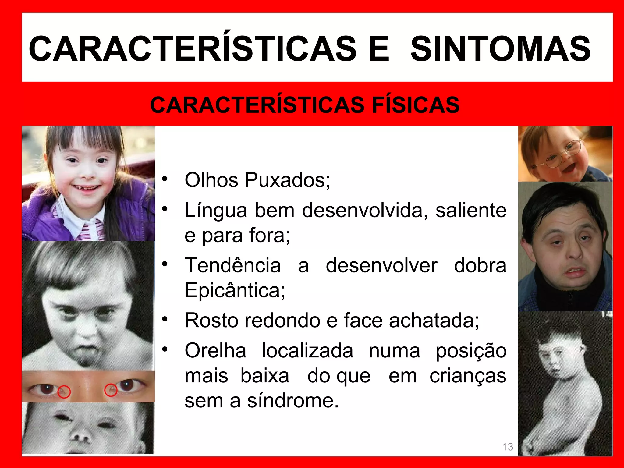 CARACTERÍSTICAS E SINTOMAS
CARACTERÍSTICAS FÍSICAS
• Olhos Puxados;
• Língua bem desenvolvida, saliente
e para fora;
• Tendência a desenvolver dobra
Epicântica;
• Rosto redondo e face achatada;
• Orelha localizada numa posição
mais baixa do que em crianças
sem a síndrome.
13

 