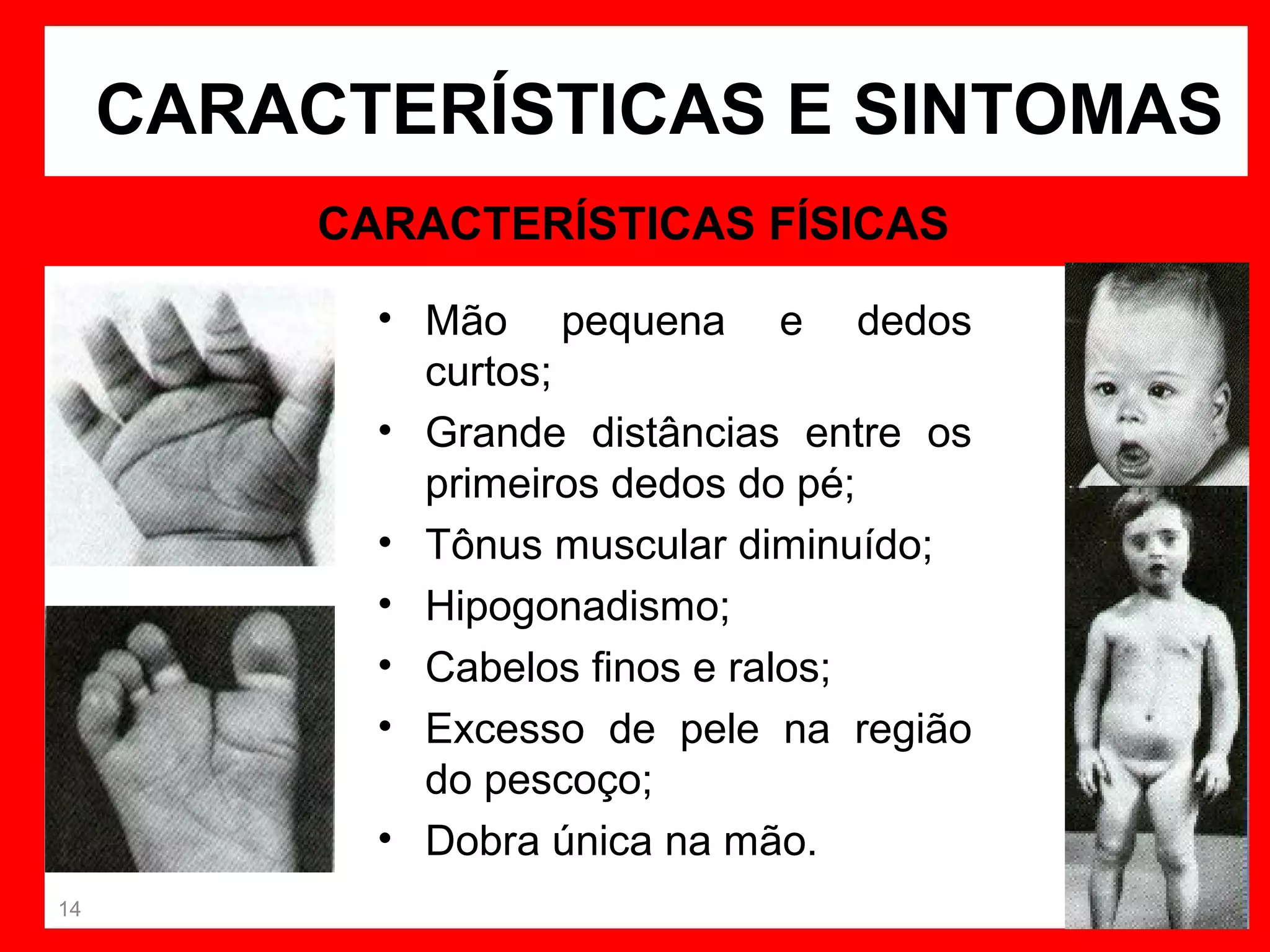 CARACTERÍSTICAS E SINTOMAS
CARACTERÍSTICAS FÍSICAS
• Mão pequena e dedos
curtos;
• Grande distâncias entre os
primeiros dedos do pé;
• Tônus muscular diminuído;
• Hipogonadismo;
• Cabelos finos e ralos;
• Excesso de pele na região
do pescoço;
• Dobra única na mão.
14

 
