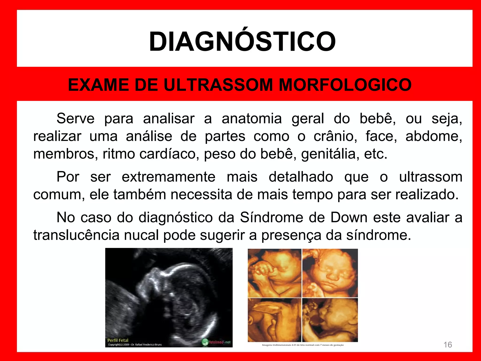 DIAGNÓSTICO
EXAME DE ULTRASSOM MORFOLOGICO
Serve para analisar a anatomia geral do bebê, ou seja,
realizar uma análise de partes como o crânio, face, abdome,
membros, ritmo cardíaco, peso do bebê, genitália, etc.
Por ser extremamente mais detalhado que o ultrassom
comum, ele também necessita de mais tempo para ser realizado.
No caso do diagnóstico da Síndrome de Down este avaliar a
translucência nucal pode sugerir a presença da síndrome.

16

 