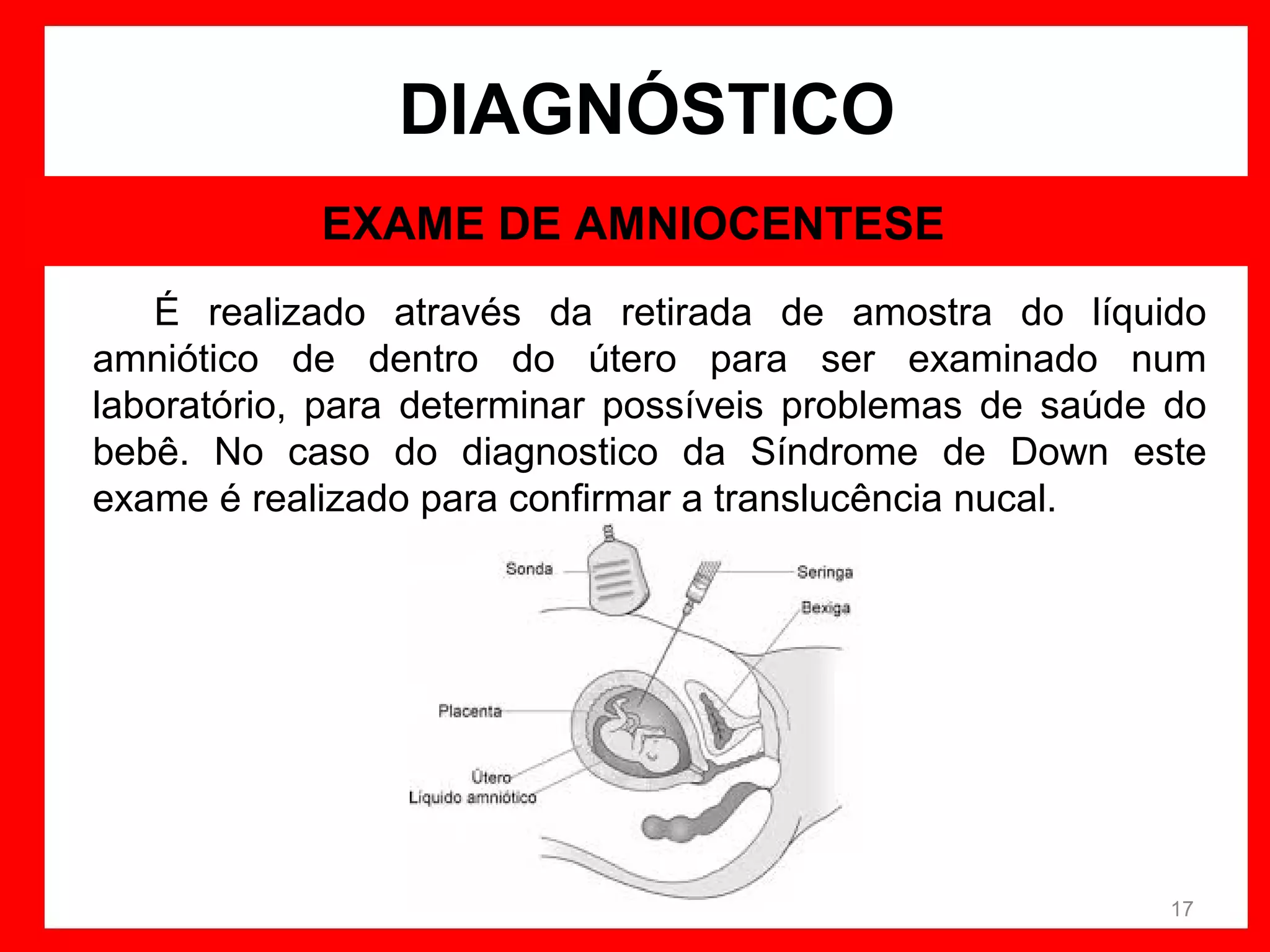 DIAGNÓSTICO
EXAME DE AMNIOCENTESE
É realizado através da retirada de amostra do líquido
amniótico de dentro do útero para ser examinado num
laboratório, para determinar possíveis problemas de saúde do
bebê. No caso do diagnostico da Síndrome de Down este
exame é realizado para confirmar a translucência nucal.

17

 